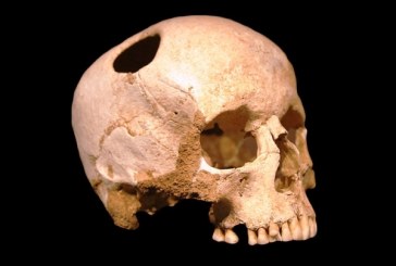 Naučnici izveli drevnu sibirsku tehniku operacije mozga